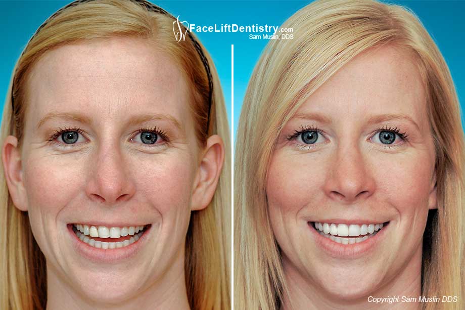 Slanting Teeth: Before and After photo showing the outcome of this treatment for slanted teeth