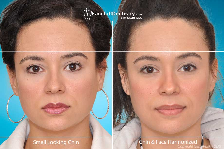 Small Chin and Short Face corrected without invasive surgery using the Face Lift Dentistry<sup>®</sup> method.
