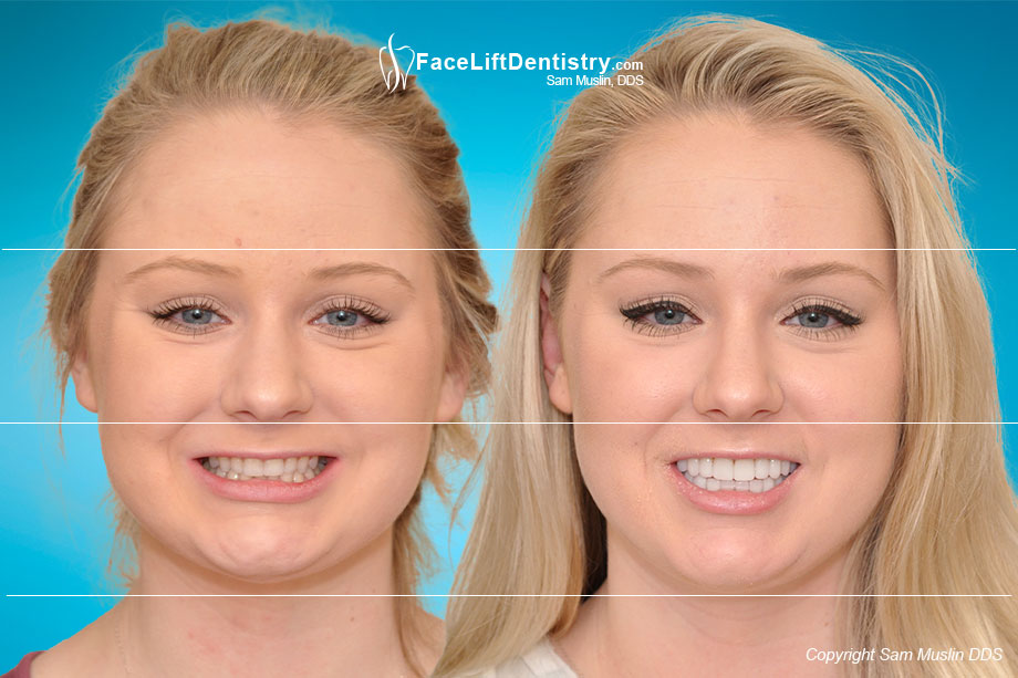  The photo on the left shows small worn teeth and an overbite. In the after photo on the right the entire face shows the outcome of treating her small teeth and bite with Face Lift Dentistry®.
