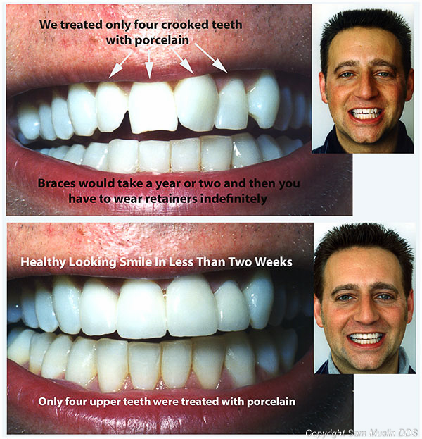 Before and after detailed photo showing straight teeth results without braces.