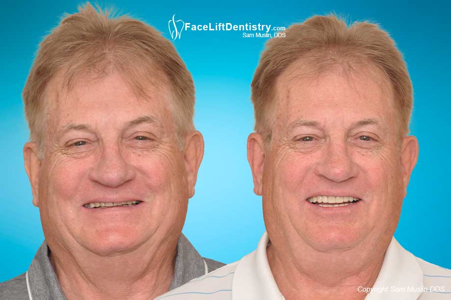 Aging teeth repaired by restoring tooth enamel - before and after