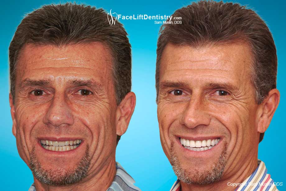 The before photo shows teeth clenching which explains TMJ problems. In the after photo the jaw is balanced with Face Lift Dentistry<sup>®</sup>.