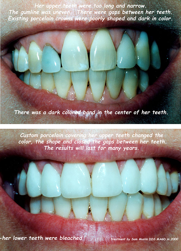  Closeup view of tetracycline stained teeth before and after treatment.
