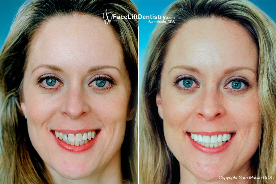  Treating Tetracycline Stains with Porcelain Veneers