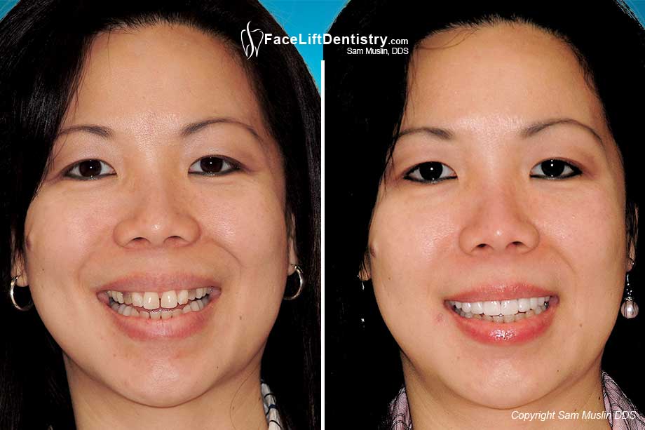 Patient with Tetracycline stained teeth before and after treatment with non-invasive veneers.