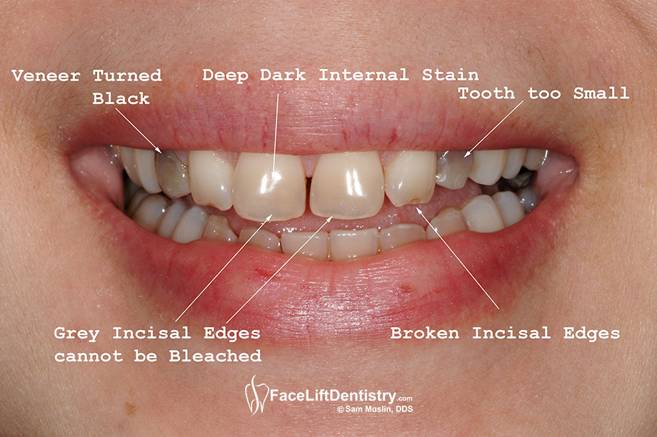  A closeup picture showing the permanent teeth stains caused by Tetracycline.