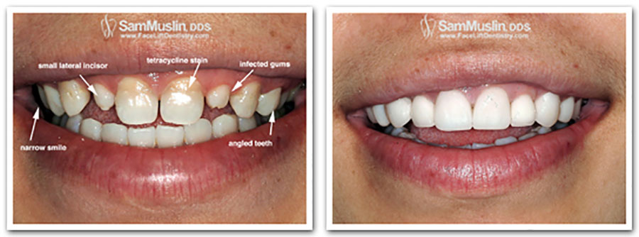  Tetracycline stained and uneven teeth treated with non-invasive porcelain veneers for a white balanced smile.