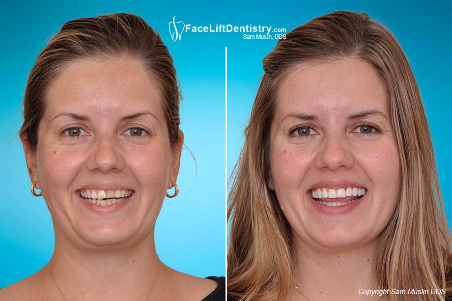 Correcting tooth discoloration - Before and After 