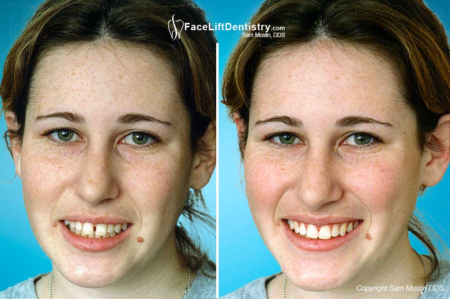  Before and After Picture showing Beafore and after Cosmetic Bonding and Aesthetic Re-Shaping