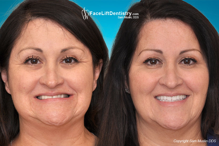 Porcelain Veneers cannot Treat an Aging Face