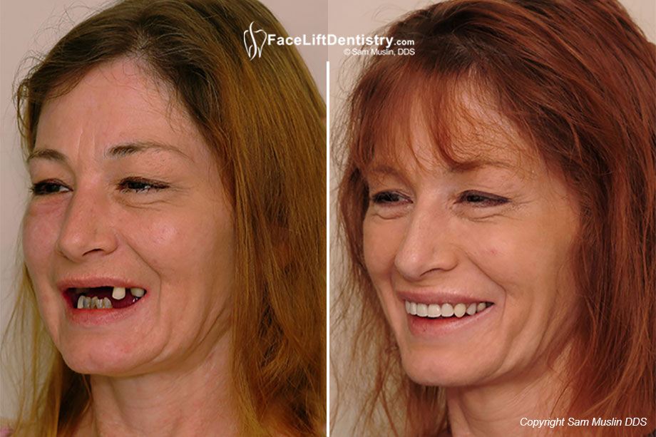 What is Face Lift Dentistry?