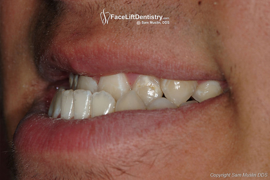Natural Treatment For Underbite Natural Treatment For Underbite