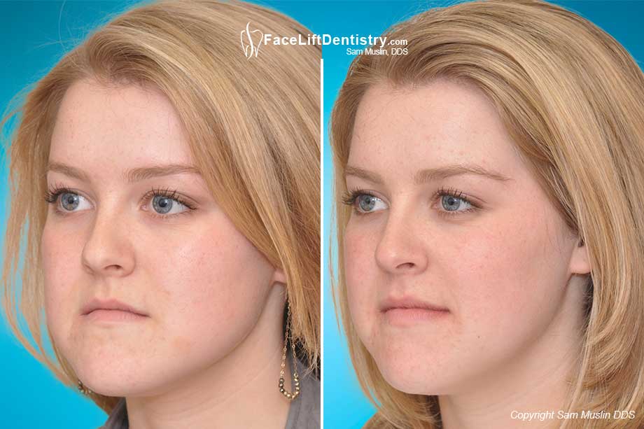 Correcting the lower jaw, chin, and underbite without jaw surgery - Before and After Photo