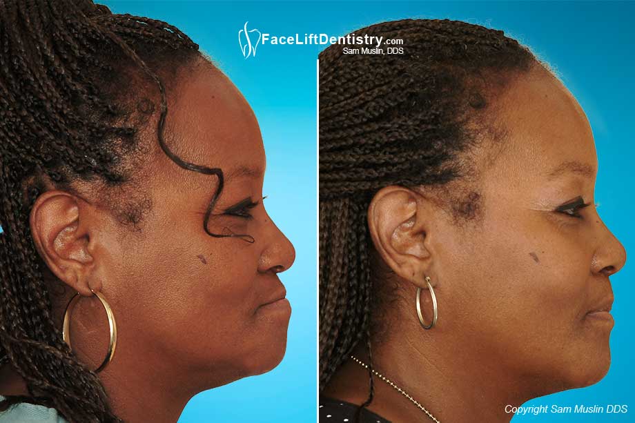 Before and After Face Lift Dentistry with Dentures