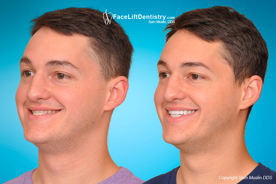 Profile photos showing the much improved underbite jaw