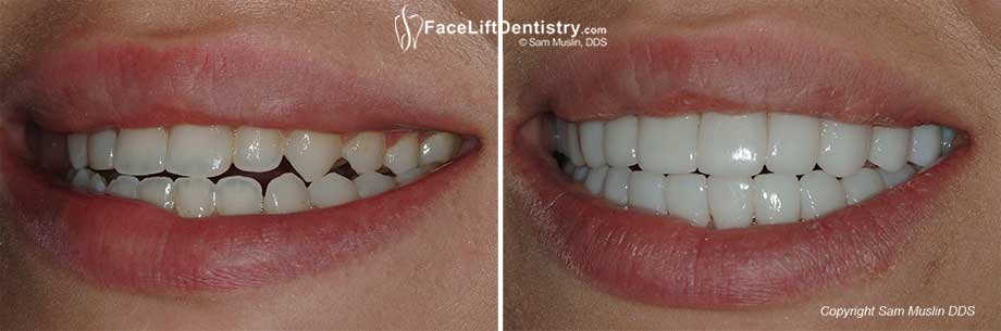 Before and After photo showing teeth closeup treated with with Venlay Restorations.