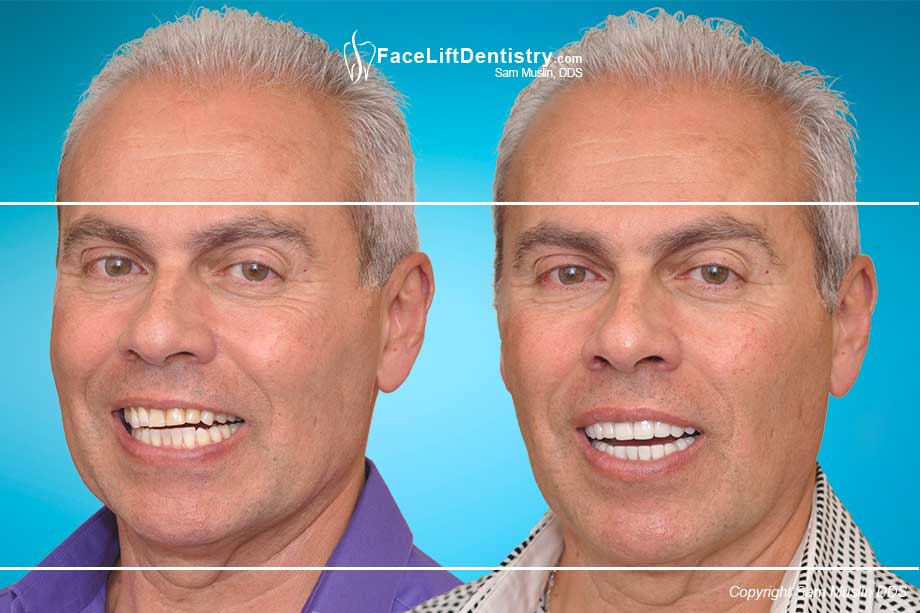 Worn Teeth resulting in a slanted smile - Before and After Treatment