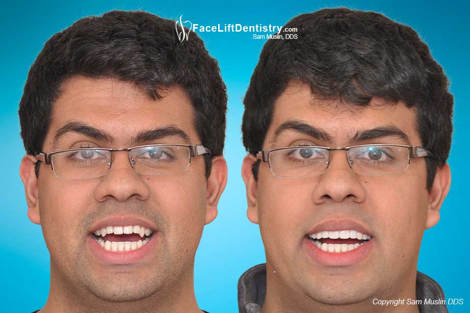  VENLAY Restorations for Underbite Correction - Before and After