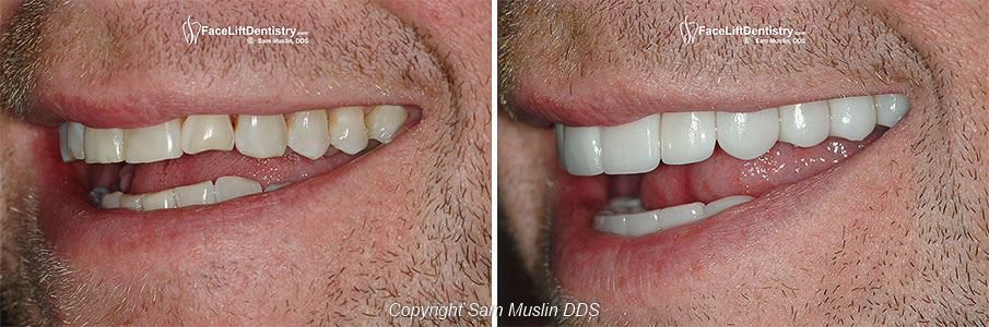 Close-up Before and After of Worn Teeth Repaired