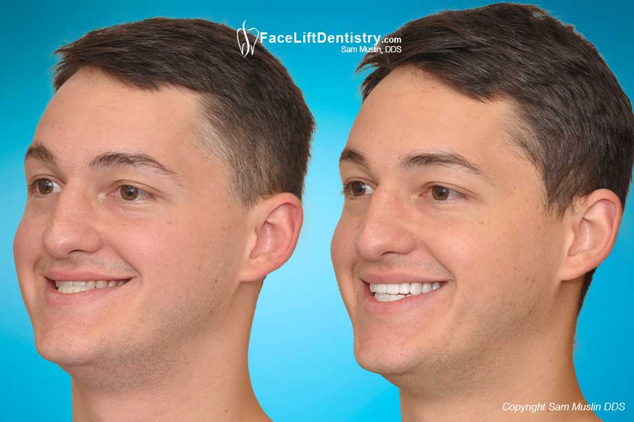 Before and After Photos Bite Correction without Surgery or Braces