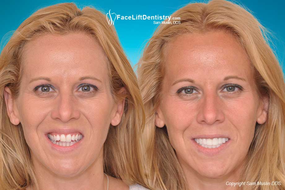 Correcting tongue thrust in adults