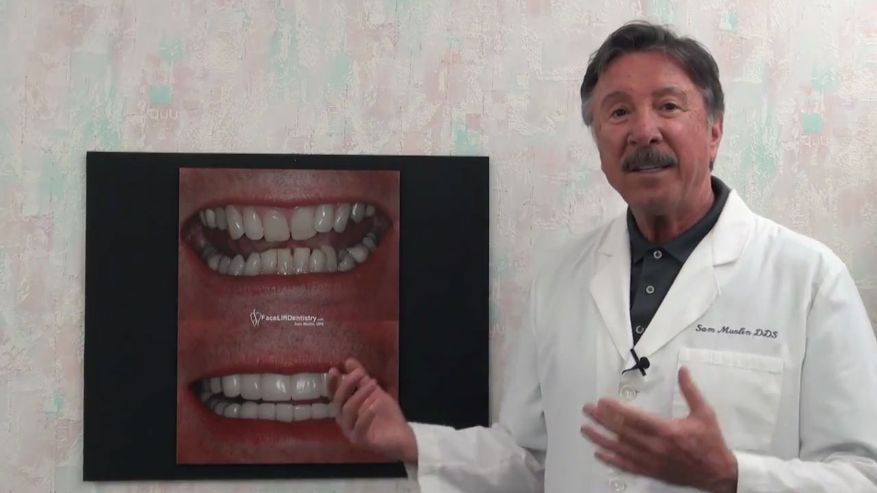 Deep Overbite Correction