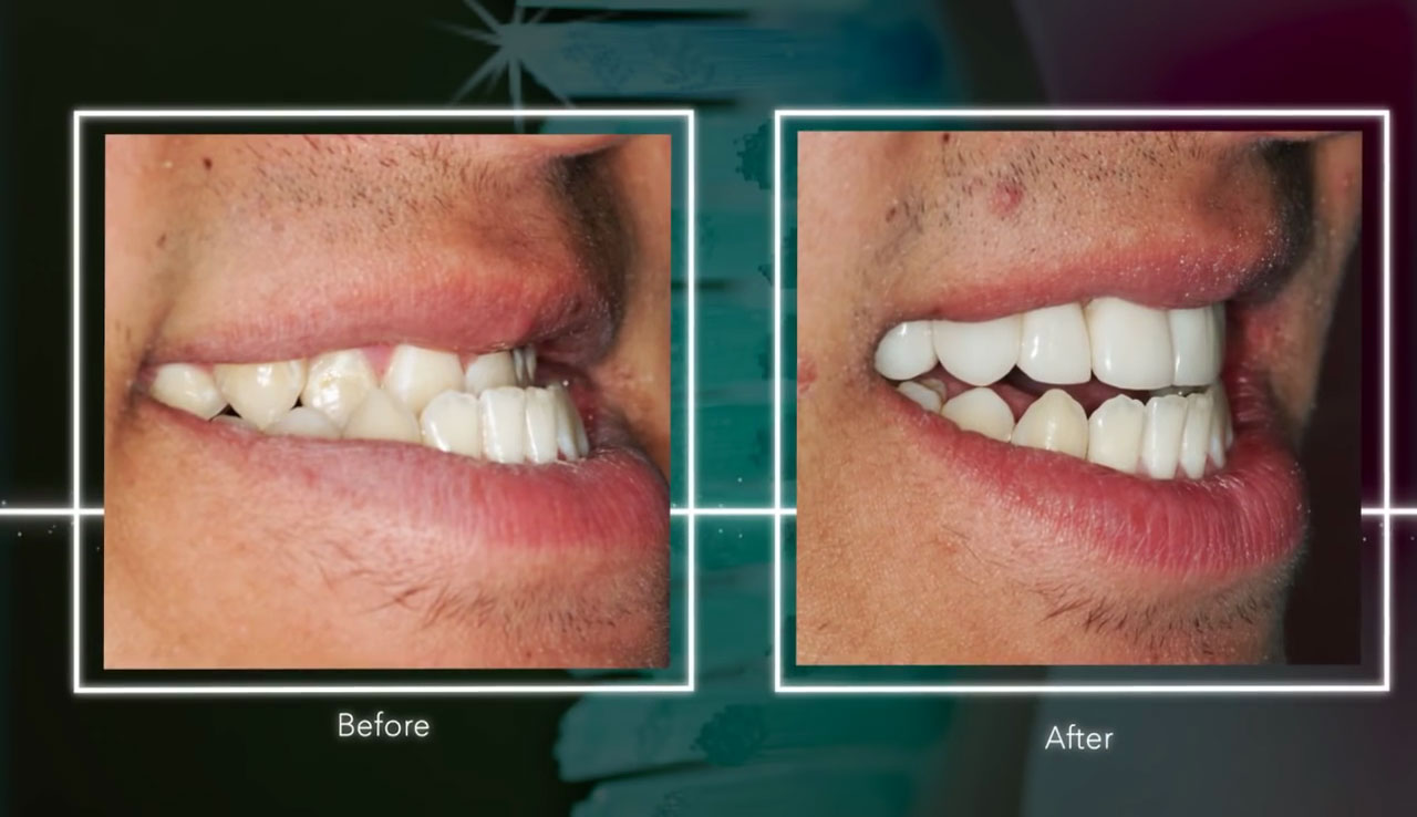 Underbite Surgery Alternative In Two Weeks underbite-surgery-alternative-in-two-weeks