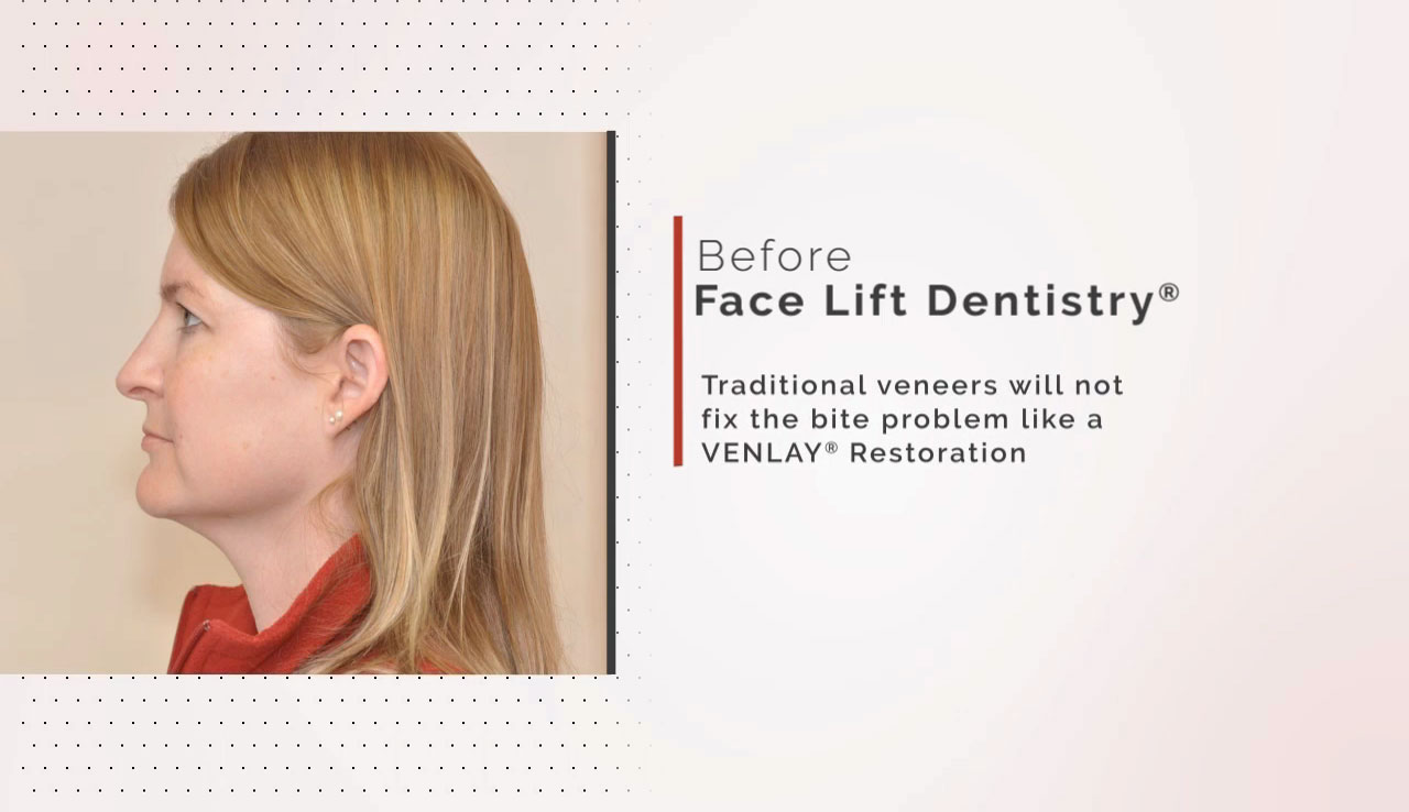 Treating a Collapsed Bite and Premature Aging