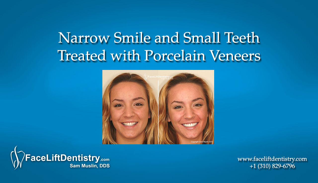 Teeth Veneers vs. Teeth Bleaching