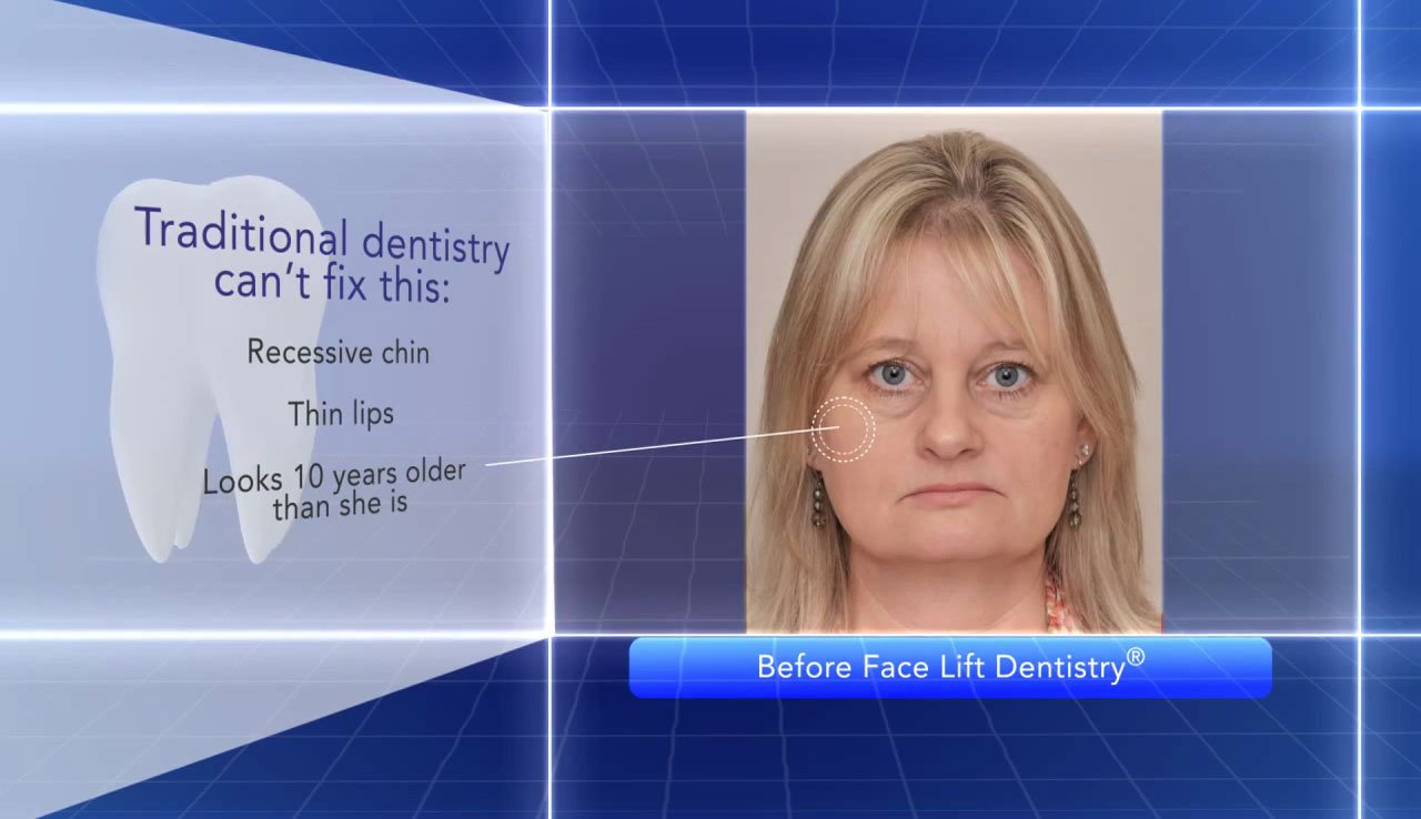 Dental Facelift Corrects TMJ and Overbite