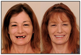 The Dental Face Lift