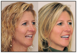 The Dental Face Lift