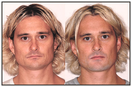 The Dental Face Lift