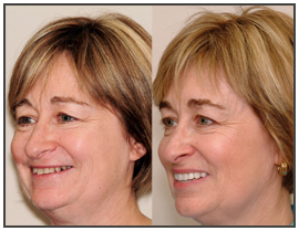 The Dental Face Lift