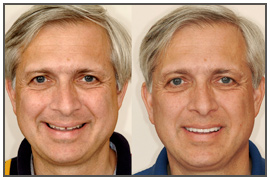 The Dental Face Lift