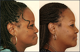 The Dental Face Lift
