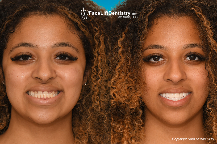 Jaw position aligned without jaw surgery, before and after