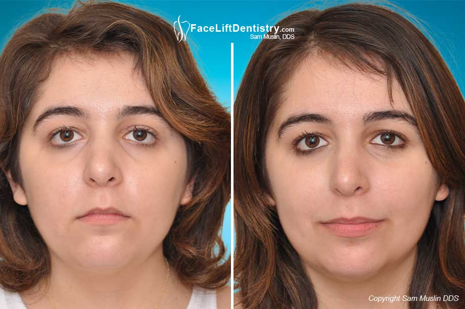 bite open correction anterior fix surgery braces face adult treatment before jaw without position
