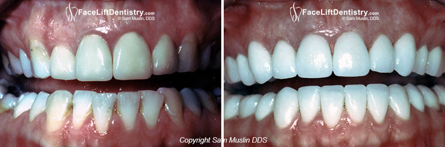  Gummy Smile fixed with Advanced Cosmetic Dentistry
