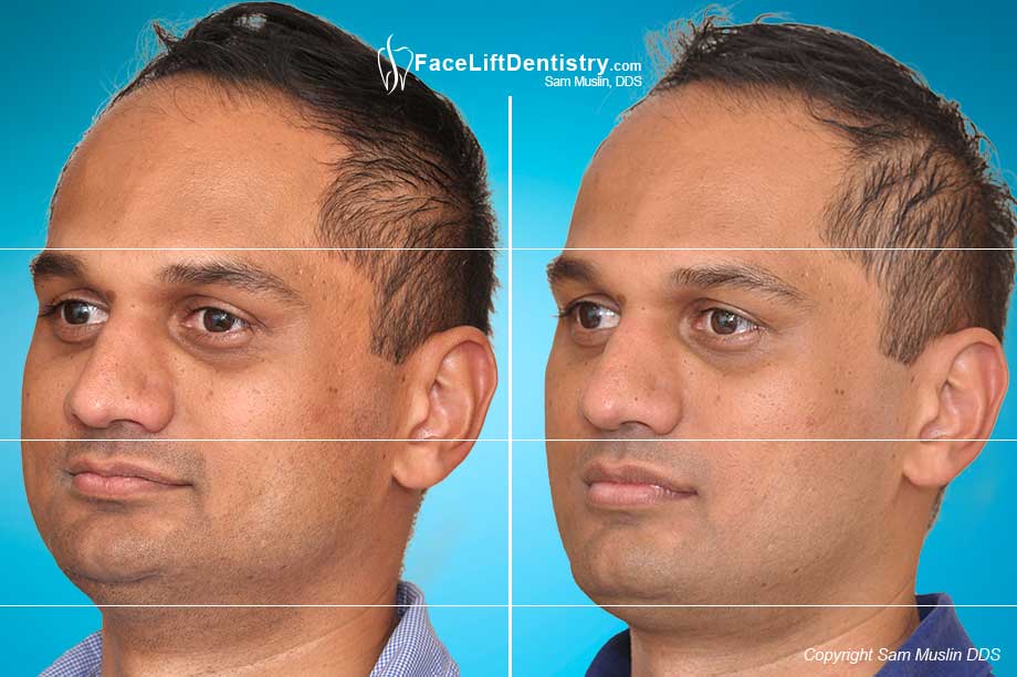 Profile after Overbite Correction performed with no aligners, braces, or surgery