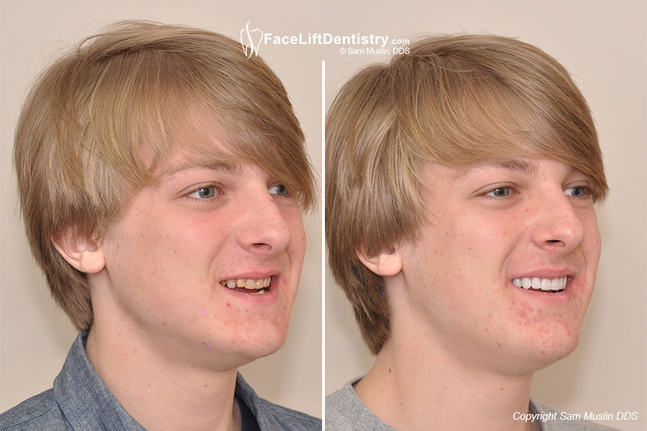 A patient with his teeth affected by Amelogenesis Imperfecta as well as a Bad Bite