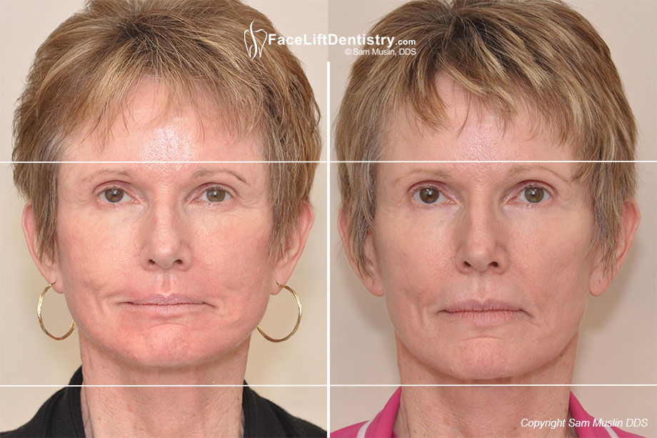 Reversing Facial Collapse by Optimizing the Jaw Position