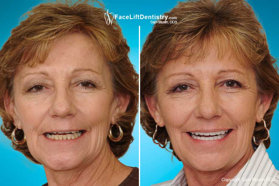 Patient in need of full mouth reconstruction, treated with non-invasive Face Lift Dentistry with reversal of premature aging effects.