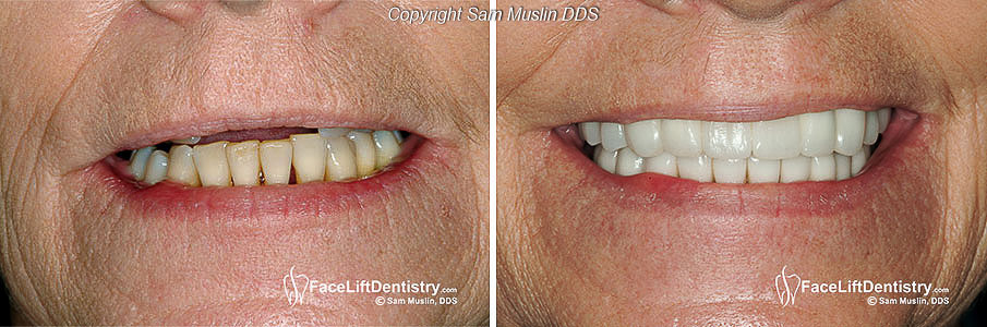 The photo on the left shows no visible upper teeth and lower teeth in need of restoration. The photo on the right shows the outcome after Face Lift Dentistry. The age reversal benefit is clearly visible.
