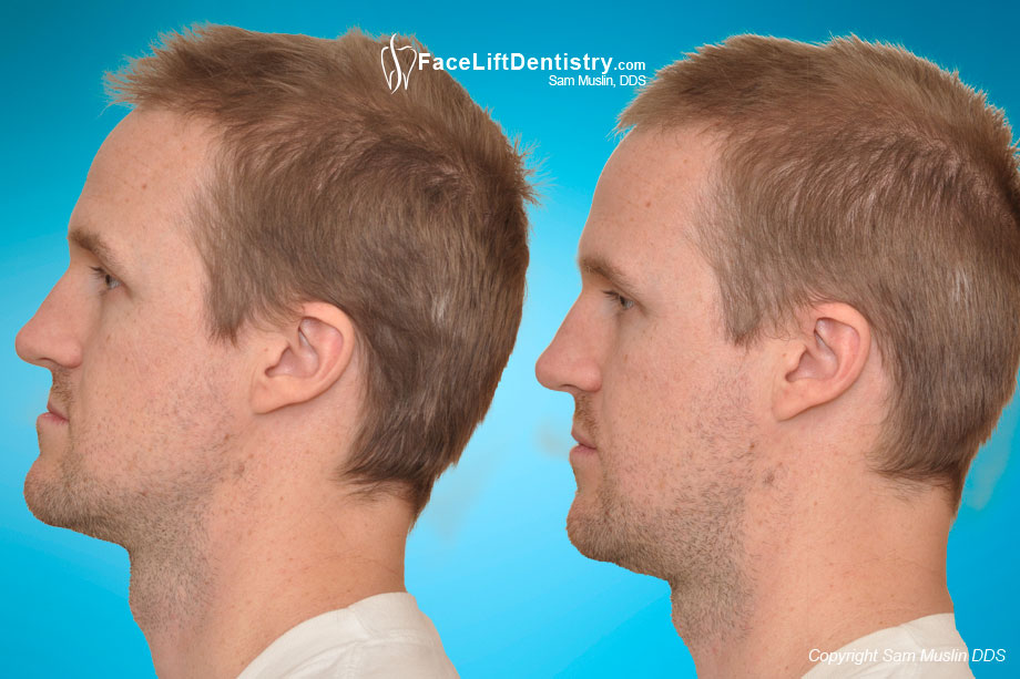 Before and after side-profile of a patient treated for his underbite showing a much better posture in the after photo.