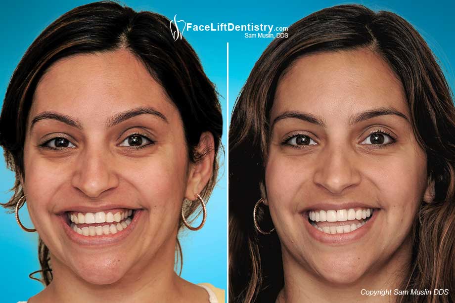 Replacing Bad Porcelain Veneers 