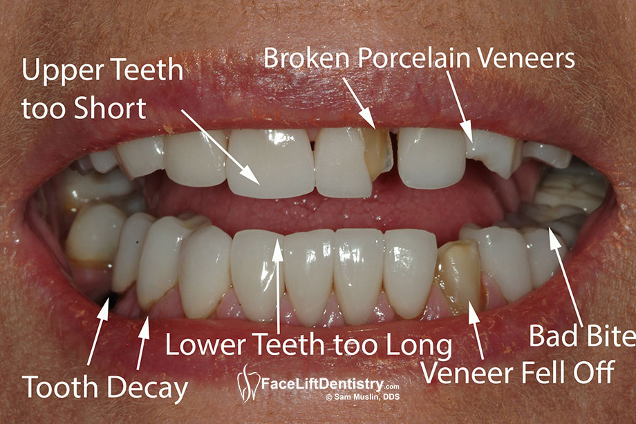  This photo shows bad, broken and lost porcelain veneers as a result of a bad bite.