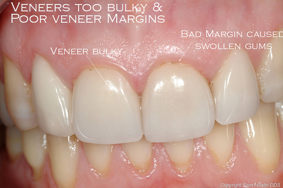 Photo of Bad Porcelain Veneers Example