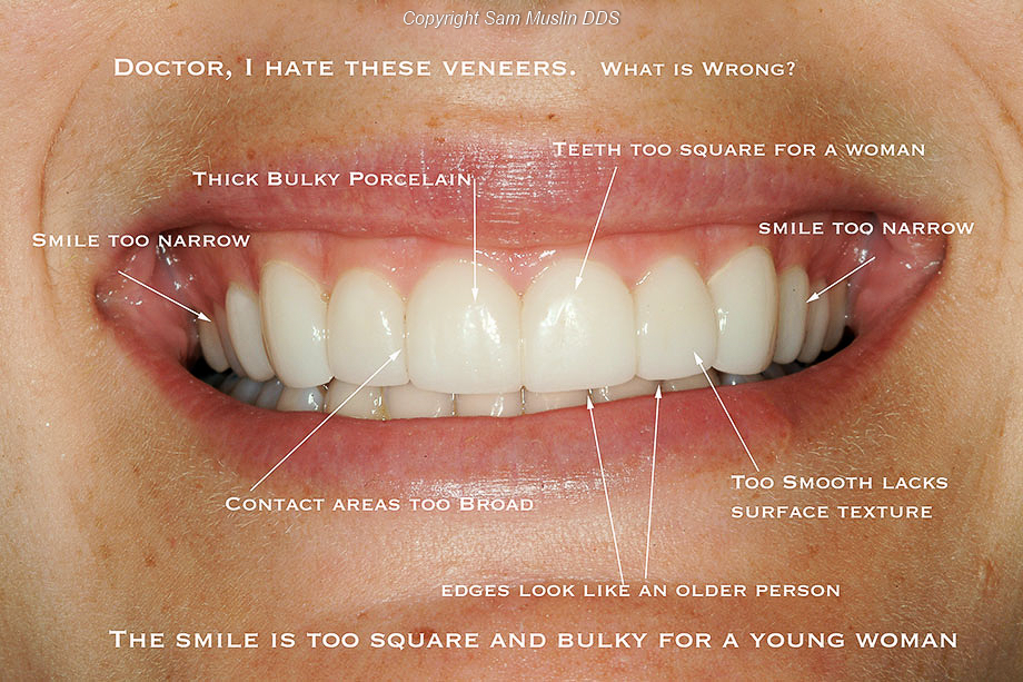 Bad Porcelain Veneers Example