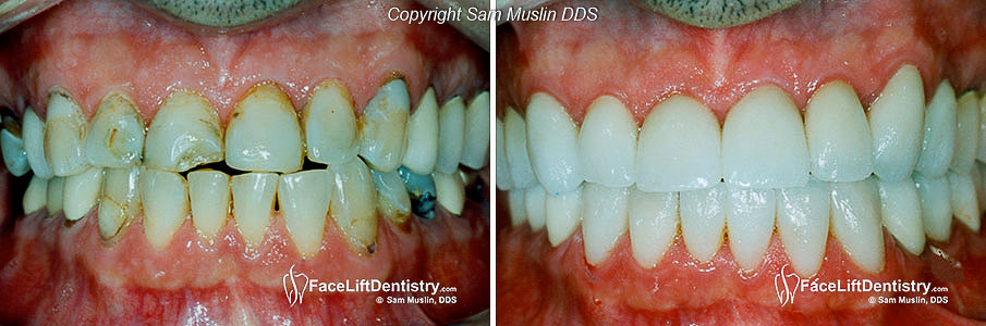  Closeup Photos showing the teeth before and after full mouth reconstruction